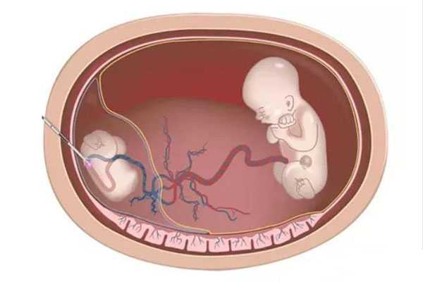 试管多次胎停_生孩子后切除子宫_试管婴儿双胞胎减胎风险有哪些？了如指掌，
