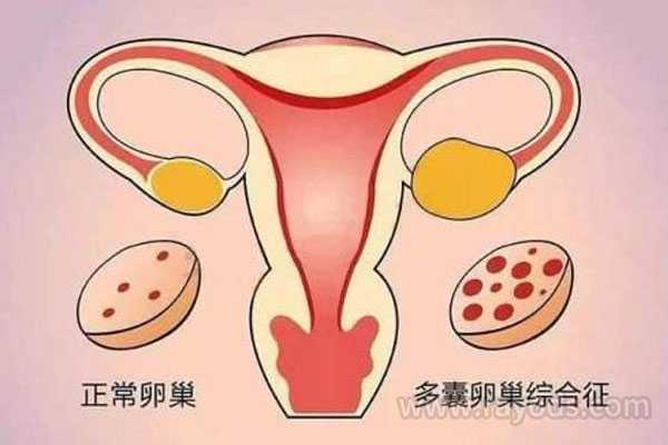 双子宫切除怀孕吗_流产很多次_48岁,卵巢不好,amh0.23,去北京协和医院做试管好吗