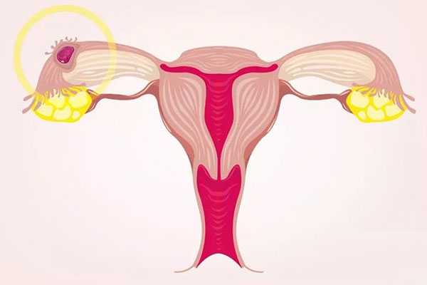 乌鲁木齐代孕法规_做试管婴儿，胚胎移植后，阴道出血该怎么办？取决于处具